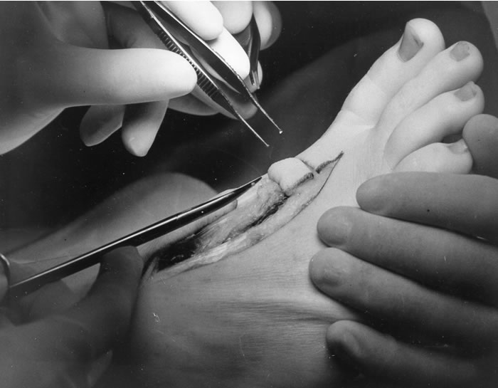 The Institute took a strategic decision to move beyond the hand in the mid- to late-1980s. Used with the permission of the Bernard OBrien Institute of Microsurgery.